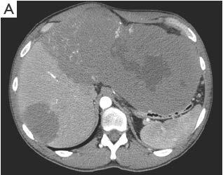 Case Presentation 65 yo Somalian man with no known liver disease presents with recent onset of abdominal discomfort, early satiety, 30 lb weight loss and lower extremity edema Labs