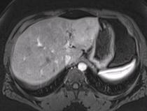 FNH - MRI Hyperenhances in arterial