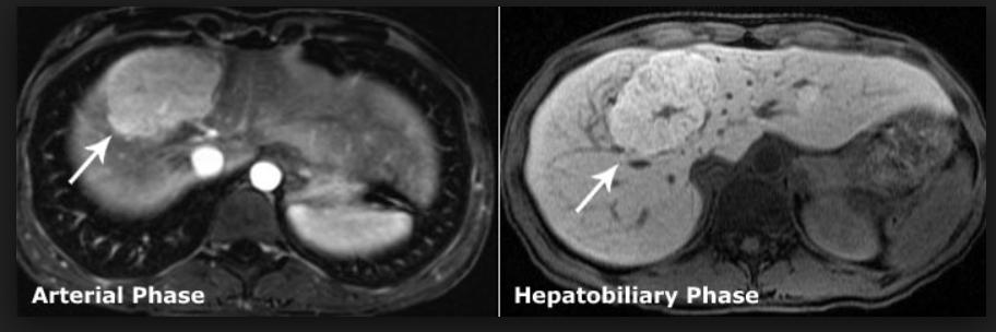 Is there imaging that can distinguish FNH from hepatic adenoma?