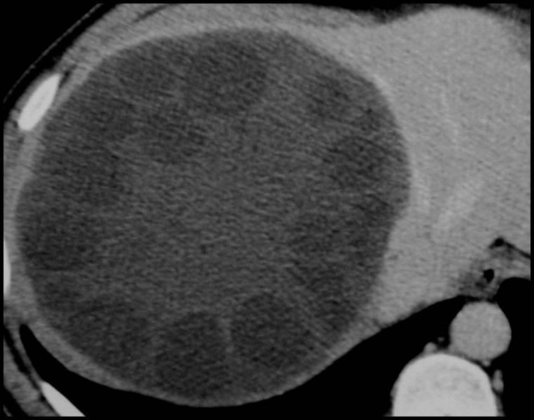 Echinococcal Cysts CT Portal