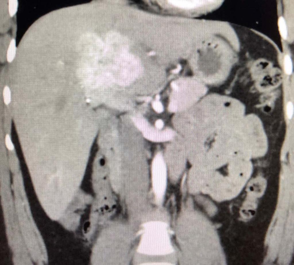 Question #1 A 25 yo AA woman with long standing asthma was noted to have an incidentally found liver lesion on cuts from her CT chest.