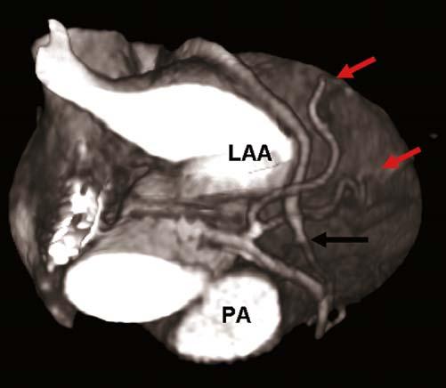 A volume-rendered image demonstrating the circumflex and obtuse marginals (red arrows) and the great cardiac vein becoming the anterior interventricular vein (black arrow).