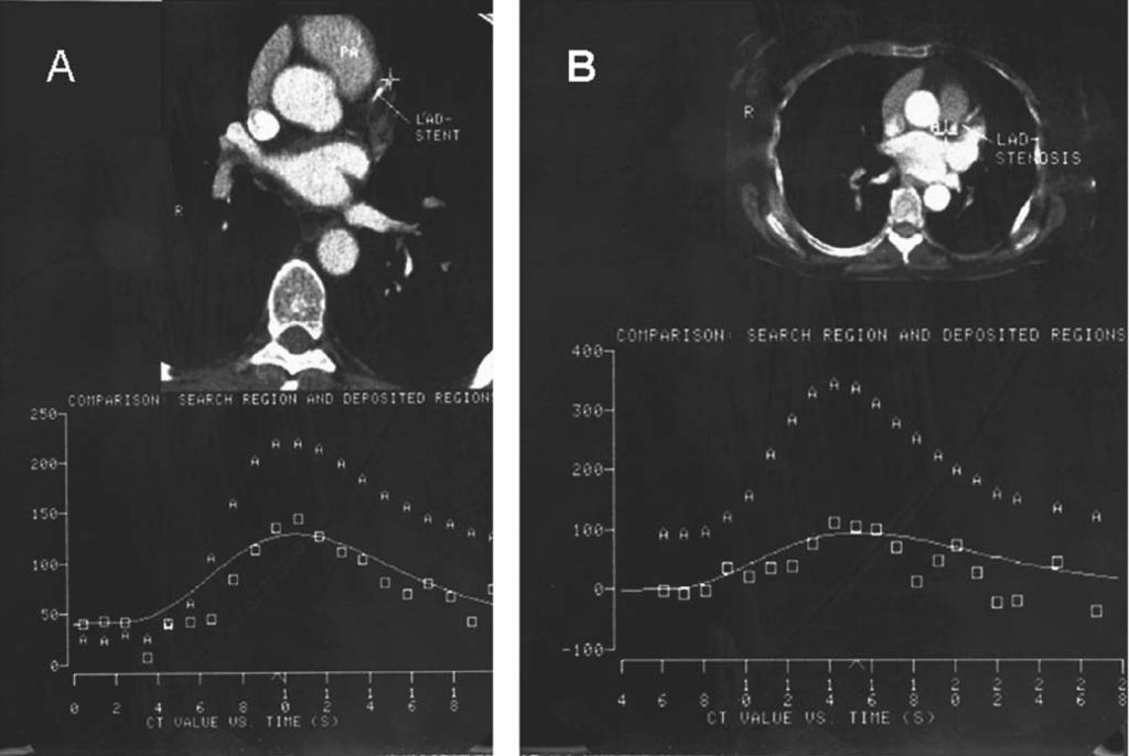52 Cardiac CT Imaging: Diagnosis of Cardiovascular Disease strated with the same gray scale value.