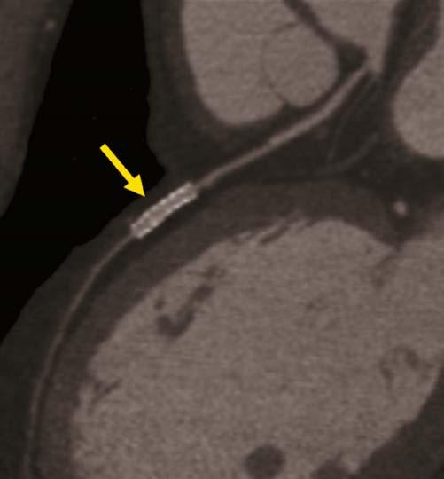 this is a relatively rare image, and in general, not the typical presentation of stents on any current cardiac CT scanner. Figure 4.9.