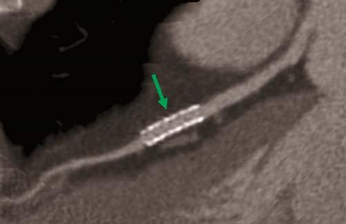 This demonstrates the problem of stent visualization currently with cardiac CT.