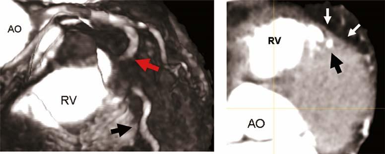 distally into the left anterior descending artery. stenosis is to look at the 2-D images, where the vessel in question will be seen as a normal, round segment, covered by myocardium.