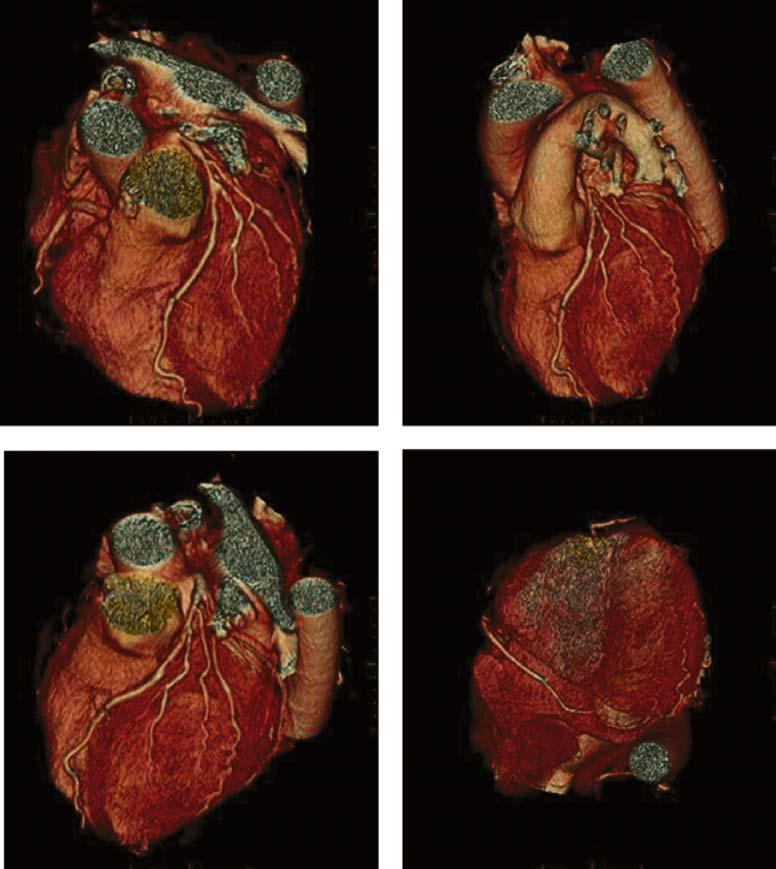 56 Cardiac CT Imaging: Diagnosis of Cardiovascular Disease Figure 4.19. A volume-rendered dataset demonstrating the coronary anatomy from multiple views.