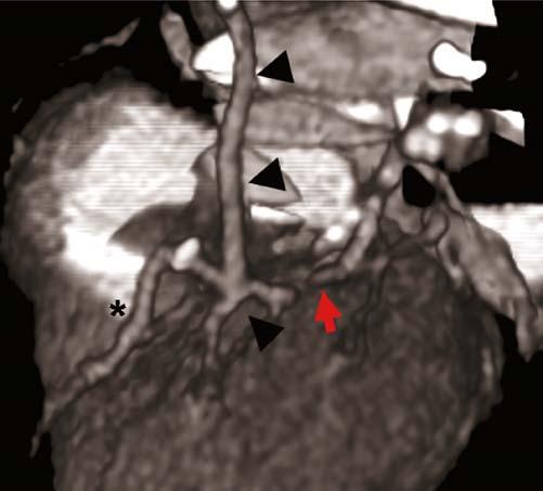 Interpreting CT Angiography: Three-Dimensional Reconstruction Techniques 57 Figure 4.20. A 64-year-old patient after bypass surgery, now with a patent left internal mammary artery (black arrows).