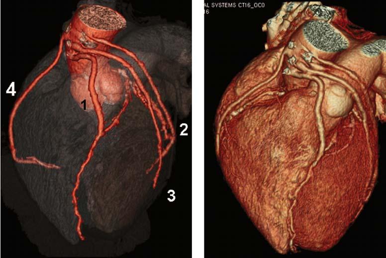 58 Cardiac CT Imaging: Diagnosis of Cardiovascular Disease Figure 4.23. A 78-year-old woman who had bypass surgery 10 years previously, now presenting with shortness of breath.