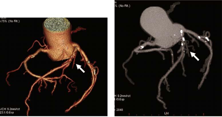 Interpreting CT Angiography: Three-Dimensional Reconstruction Techniques 59 Figure 4.26. Two reconstructions of the same patient.