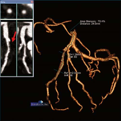 60 Cardiac CT Imaging: Diagnosis of Cardiovascular Disease Figure 4.28.