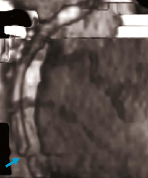 While this is not a dramatic artifact in this case, accurately diagnosing stenosis in these areas is not possible.