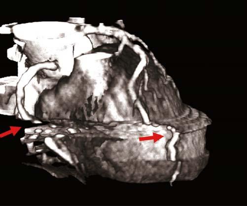 64 Cardiac CT Imaging: Diagnosis of Cardiovascular Disease Figure 4.35. A breath-holding artifact during a cardiac CT scan.