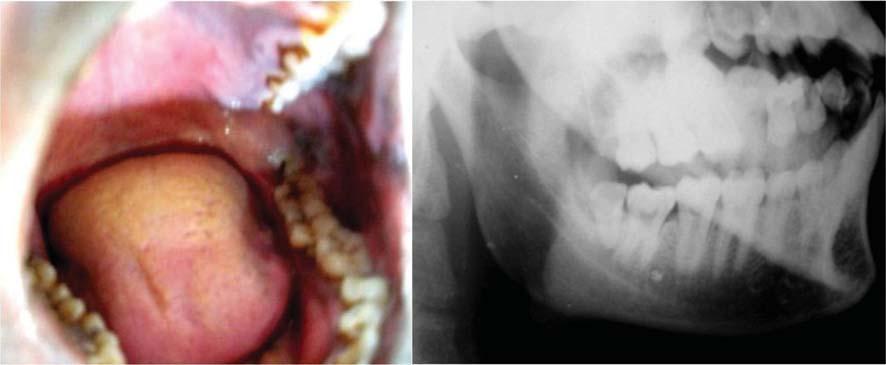 Supernumerary teeth in non-syndromic patients the left side and the mouth opening was normal. On the examination, the gingival operculum distal to the third molar was inflamed and tender on palpation.