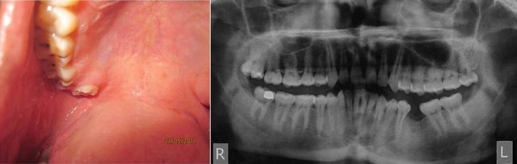 The provisional diagnosis was pericoronitis and a lateral oblique radiograph was advised in order to evaluate the region accurately. There was no relevant familial history of dental abnormalities.