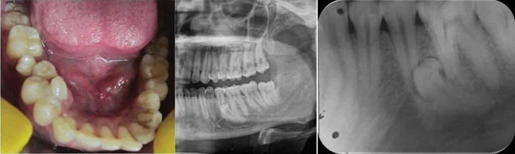 Supernumerary teeth in non-syndromic patients C Fig. 4. Case 4.. Intraoral photograph shows three supernumerary teeth lingual and distal to the right mandibular premolars.