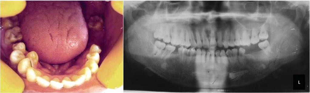 Intraoral periapical radiograph shows the presence of a dilacerated premolar-like tooth between the second premolar and the first molar. Fig. 5. Case 5.