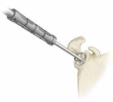 Drill Glenoid Plate Hole C Cannulated