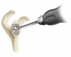 Exposure of the glenoid also will be facilitated by use of specific retractors. For a deltopectoral approach, a Posterior Glenoid Retractor is essential.