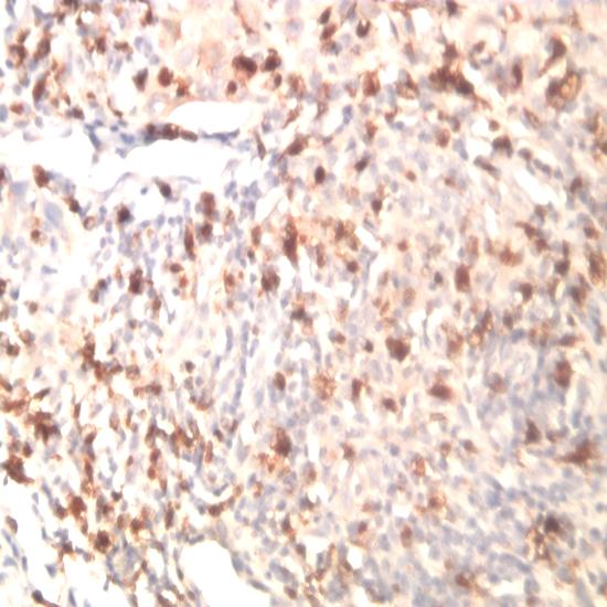 a Basal Cell Carinoma Squamous Cell Carcinoma b * 175 150 125 100 75 50 25 p- value < 0.