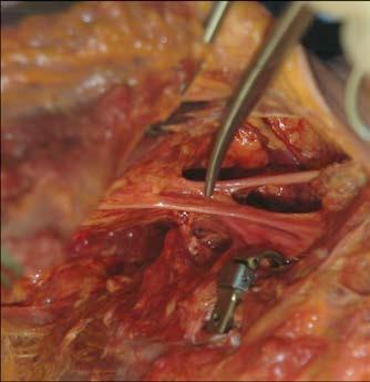Brachial Plexus Palsy Injuries First rib adjacent to