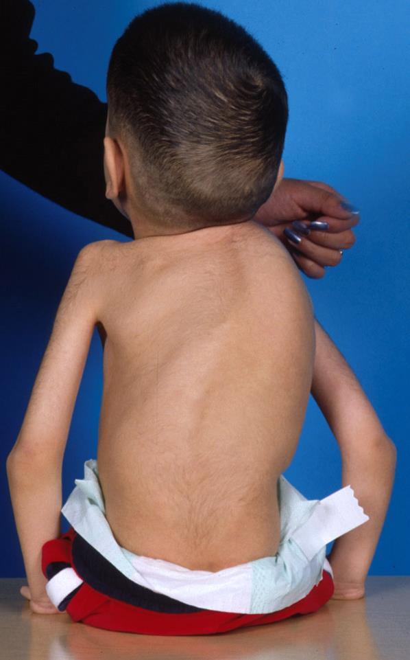 Early Onset / Congenital Spine Deformity What Do We Know?