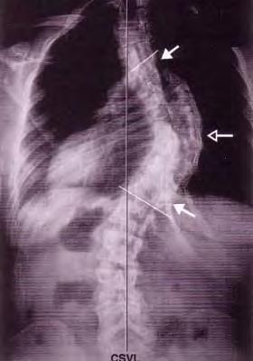 Imaging Apex: center, most laterally deviated disc or vertebra Apical vertebra(e): most horizontal at