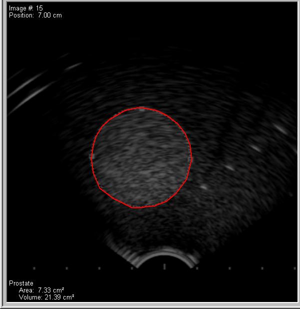 Test 8: TPS volume accuracy Perform a volume study of 3D target in the US phantom Import ultrasound images into treatment planning computer Retrace contours in