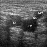 Evidence for Mickey Mouse Sign Duplex Ultrasound Investigation of the Veins in Chronic Venous Disease of the Lower Limbs UIP Consensus Document. Part I. Basic Principles P. Coleridge-Smith, N.