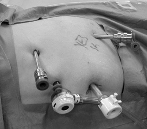 RAPN: OFF-CLAMP TECHNIQUE 5 FIG. 1. Trocar placement. A 12-mm trocar is placed above the umbilicus.