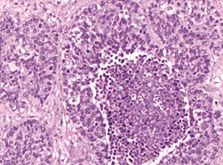 However, the assessment of the two diagnostic parameters may be affected by high subjectivity (4): the low number of mitoses in a rather large microscopic area, the fact that mitoses are not