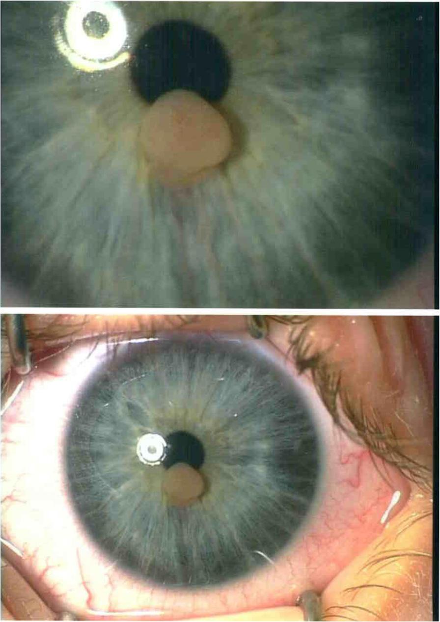 portable slit lamp, they found a vascularized lesion that seemed to originate from the superficial iris stroma. The intraocular pressure was normal in both eyes.