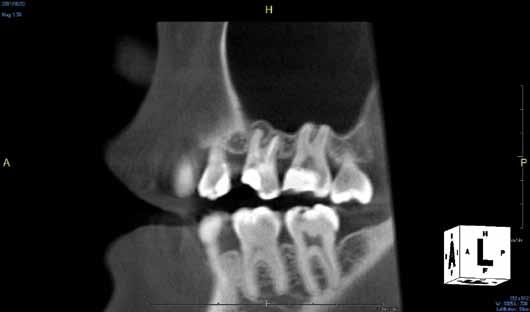 In some cases adequate bone is not available post extraction and grafting can be a necessity. The following case is a good example of this problem.