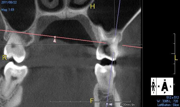 It also shows a collapsed sinus extending into the furcation of the roots. The coronal cross section (Fig. 2) clearly shows both gross decay and a severely pneumatized sinus.
