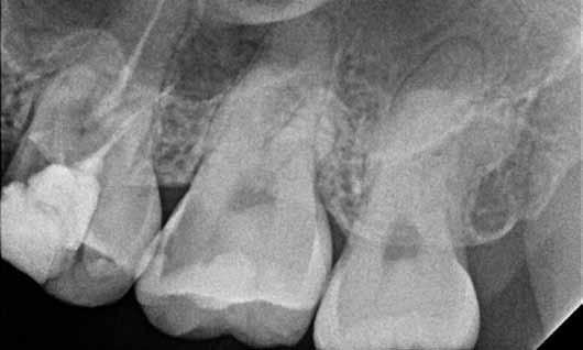 With a normal panorex scan a lateral wall sinus lift and graft
