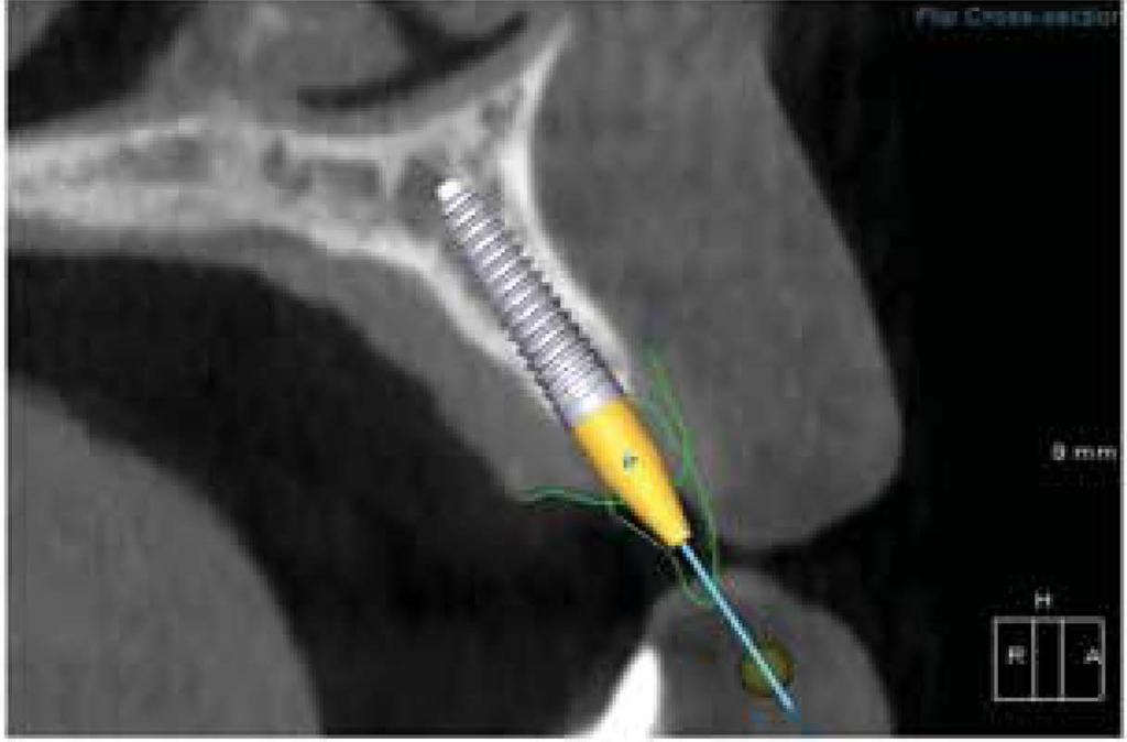 itero Scan l J itero Scan performed on patient 2J CBCT Scan performed on patient 3J