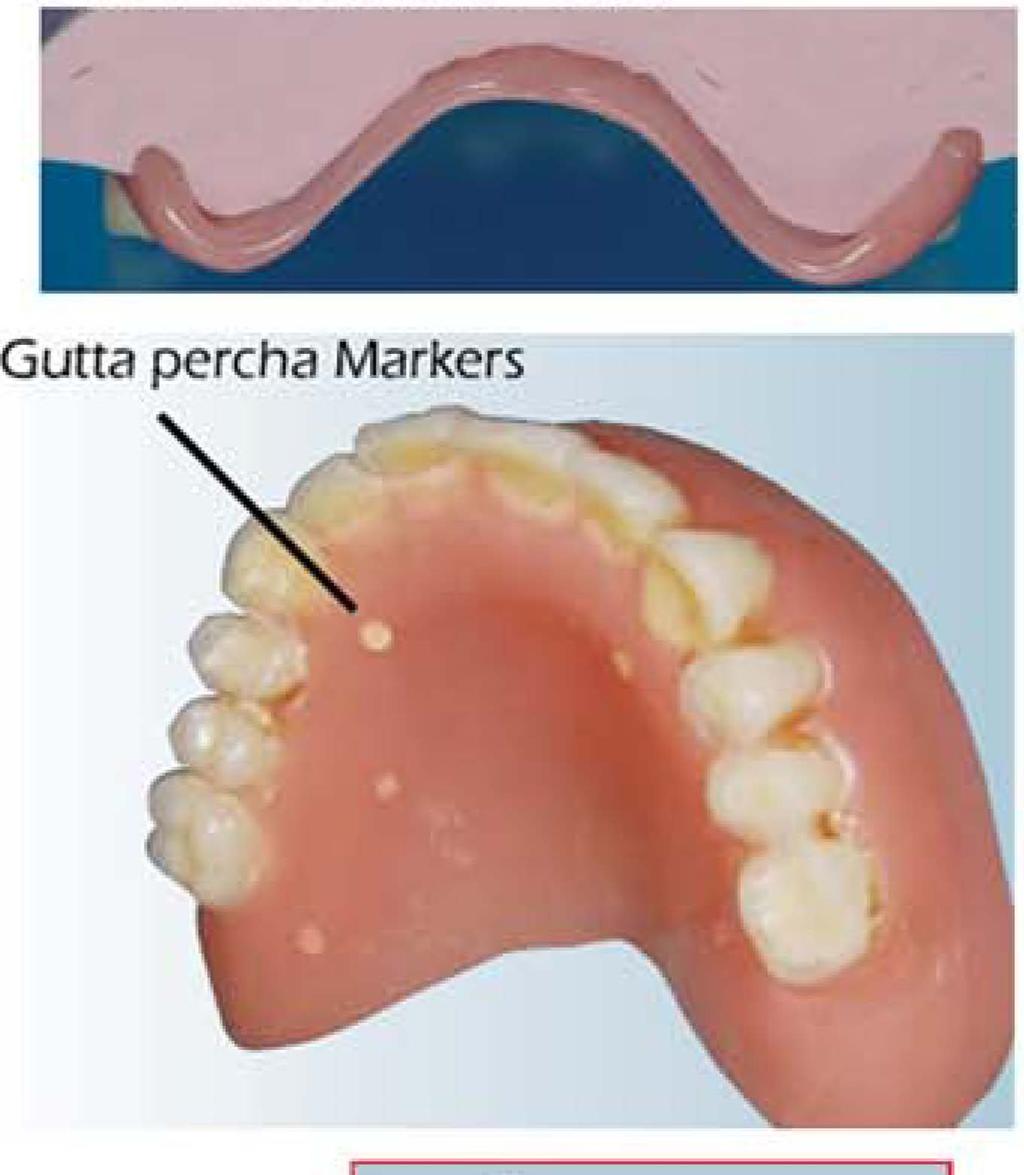 5-3mm thickness - Buccal flanges w/ length for gutta percha markers - Hard refine only - no soft refine - Excellent fit to soft tissue and Fit of denture to cast patient