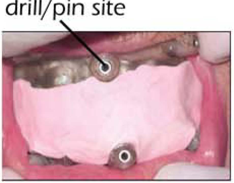 followed the Dual Scan will show that the intaglio surfaces of the surgical guide and denture are ensured to have an identical fit to the cast and patient.