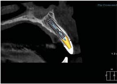 scans if the tooth being extracted represents the final prosthesis - If not representative, a virtual wax up by CyberMed/Lab is required crown that represents cont position of final