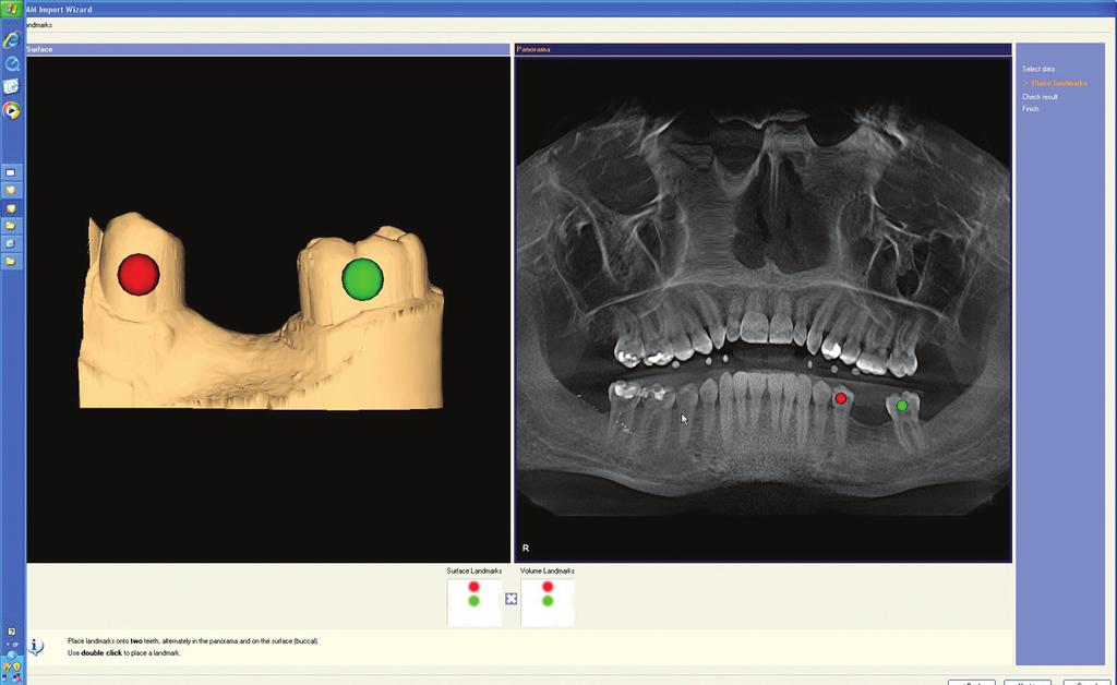 The software s implant planning functionality such as marking the nerve canal in the mandible and selecting realistically displayed implants from the clinician s manufacturer