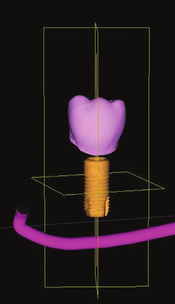 Essentially, the new integration software allows one to design an ideal crown on an exact virtual bony model of the patient (Figure 12).