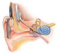 If your child has a hearing loss your options include: Hearing Aids Cochlear implant Bone conduction system How does a cochlear implant work?
