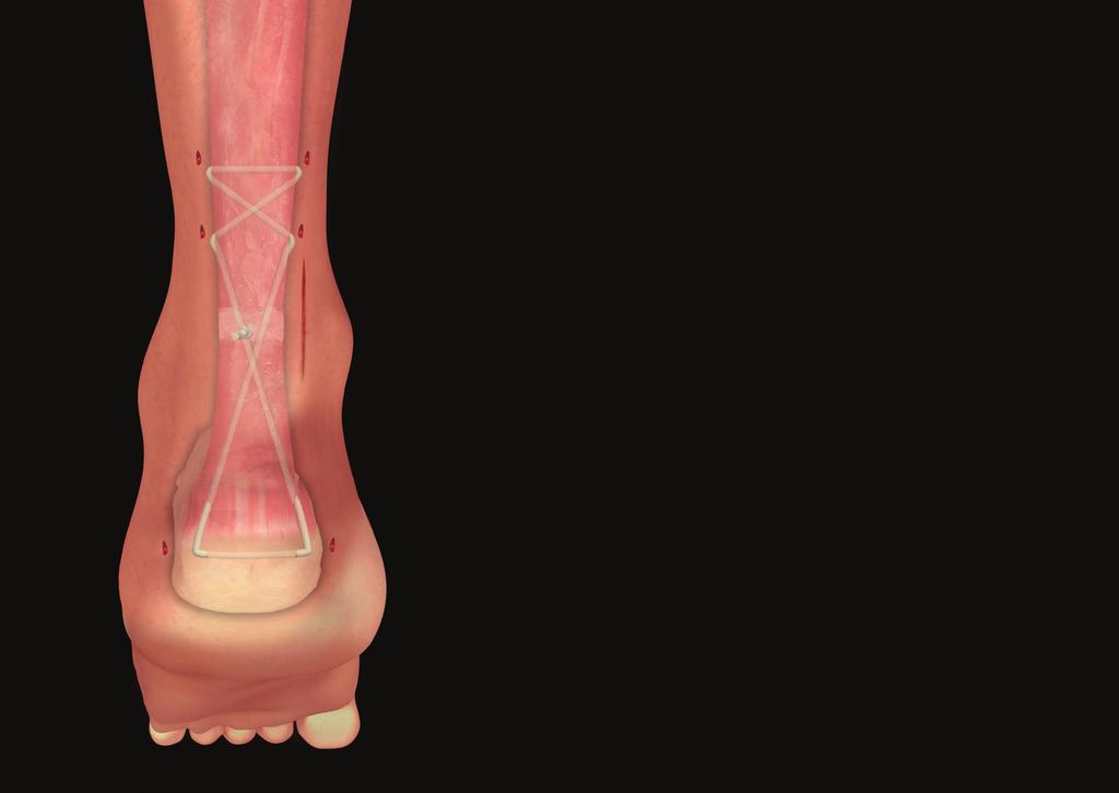 INDICATIONS The AchilloCord PLUS is a single use device intended to be used for Achilles tendon repair in patients with acute rupture of the Achilles tendon.