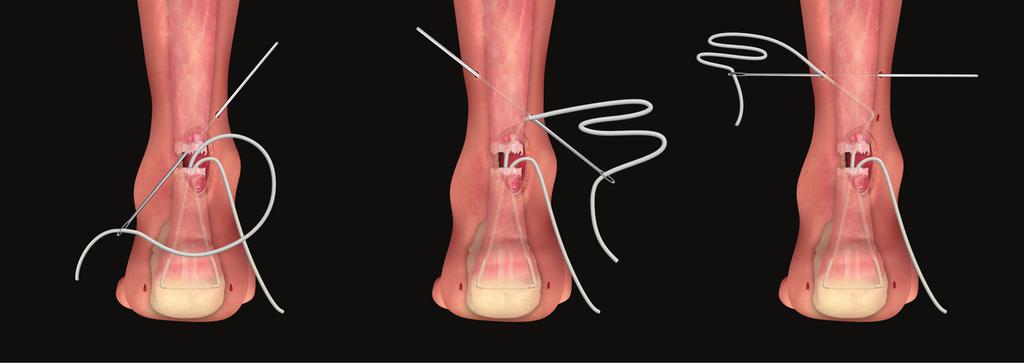 6 7 8 THREADING THE ACHILLOCORD PLUS THROUGH THE PROXIMAL END OF THE RUPTURED TENDON Where possible, the proximal end of the Achilles tendon is held with forceps and pulled down to approximate it to