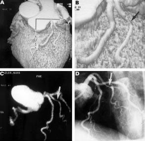Electron beam CT coronary angiography after myocardial infarct 491 Figure 2 Thirty nine year old male patient after anterolateral myocardial infarction.