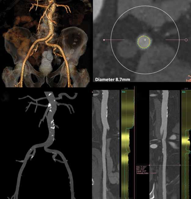 A B Figure 1. Preprocedural imaging assessment of the peripheral vasculature using 3mensio postprocessing imaging software (3mensio Medical Imaging BV, Bilthoven, The Netherlands).