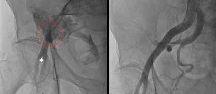 An axial view of the common femoral artery and assessment of vascular dimension (C). The insertion of a virtual 18-F delivery sheath in a stretched view of the peripheral vasculature (D). A Figure 2.