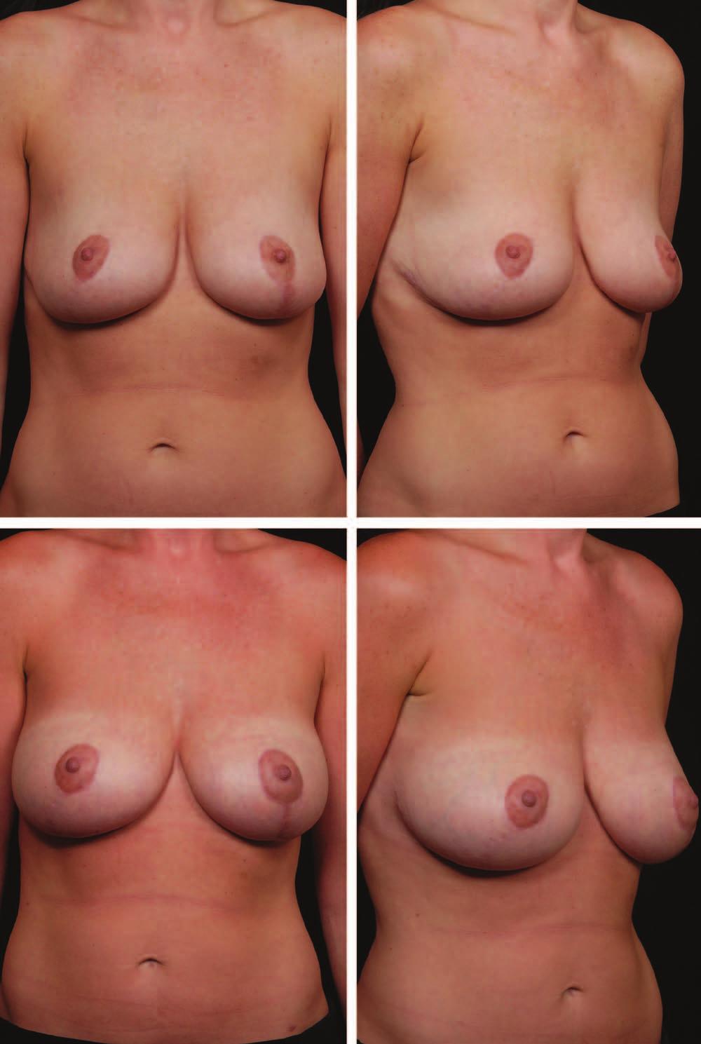 Hidalgo and Doft Postreduction Breast Augmentation Fig. 1.