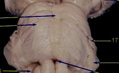 The Pons Anterior surface: - Has a median basilar groove for basilar artery (15). - Pyramidal eminence (16) on either side of basilar groove with transverse pontine fibers.