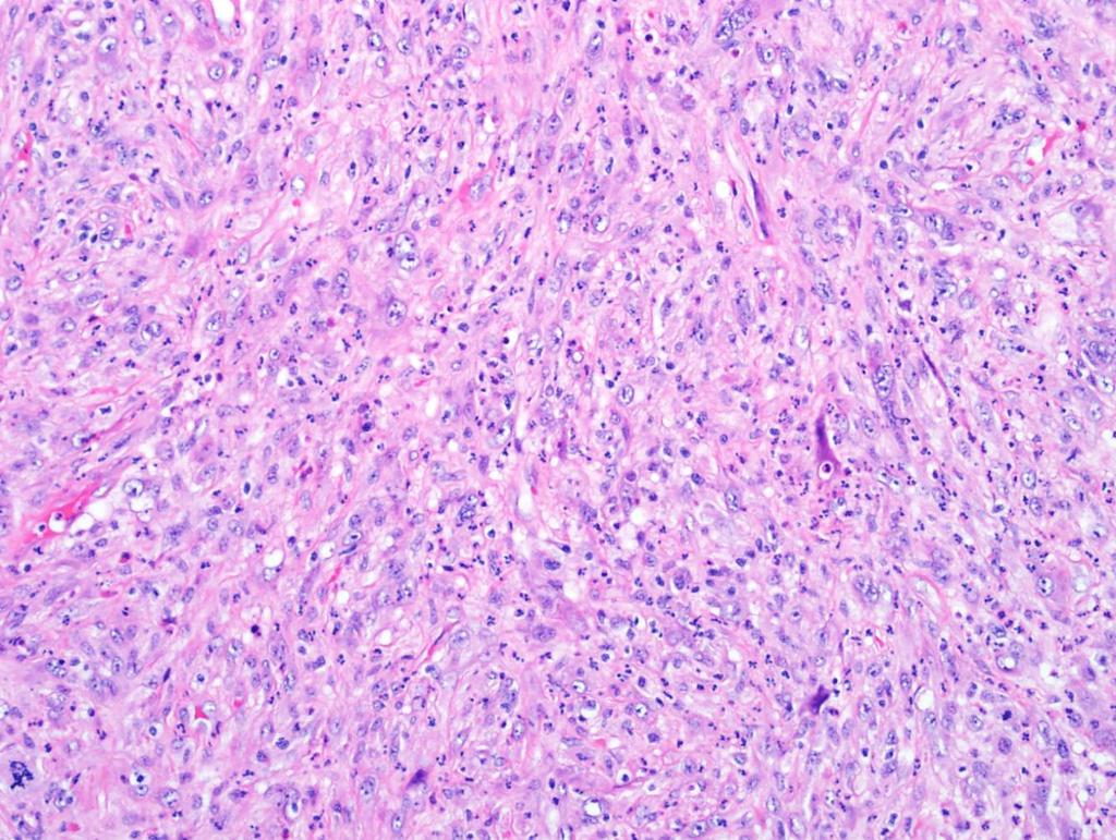 70 year old with retroperitoneal mass What now? Think about common things carcinoma, melanoma, lymphoma. Done. Now what?